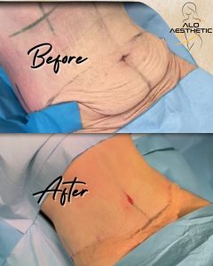 abdominoplastia antes y despues