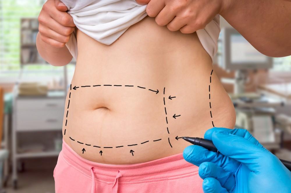 cirugia de abdominoplastia