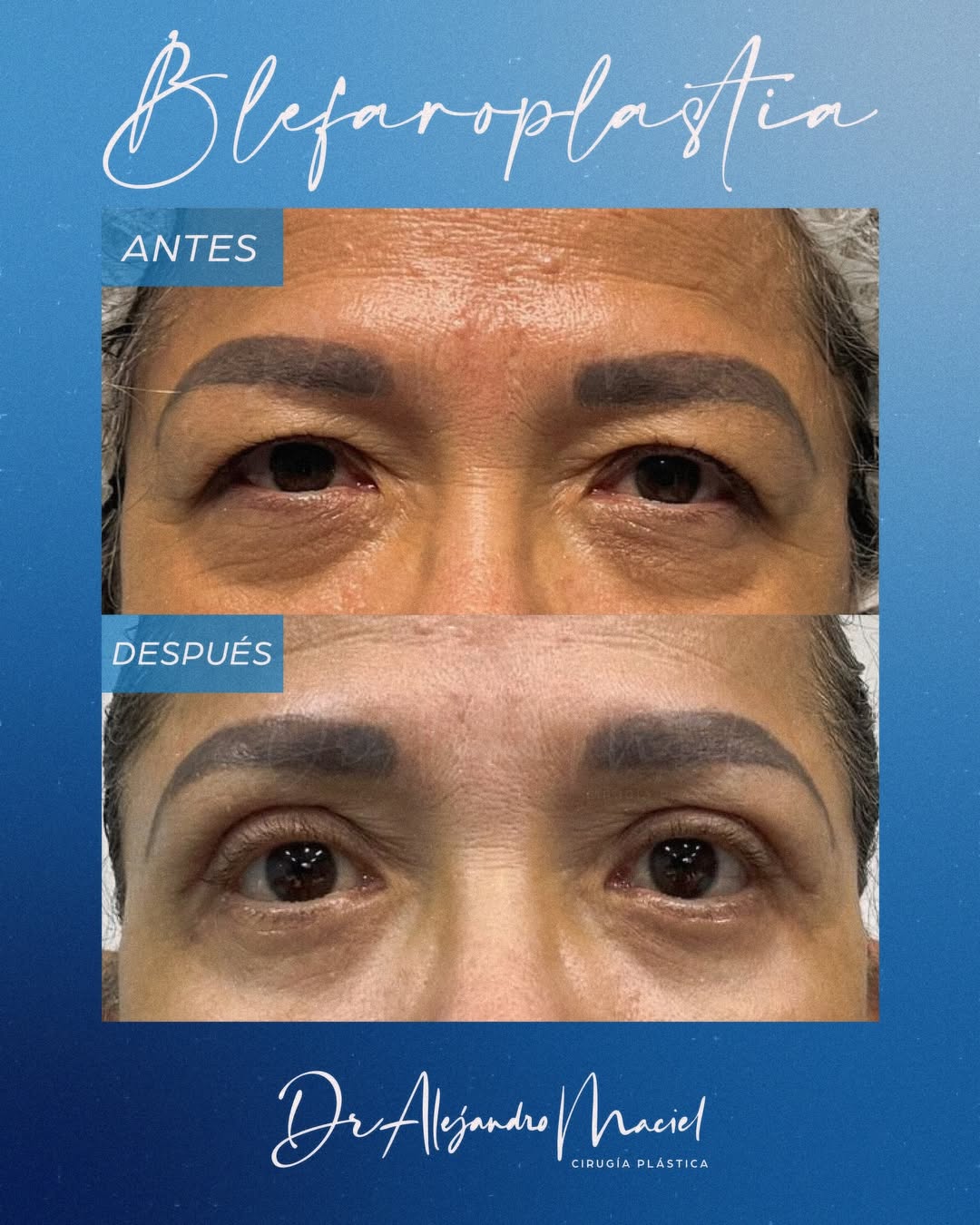 Dr. Alejandro Maciel. Before and after results of real patient. ALO Aesthetic.