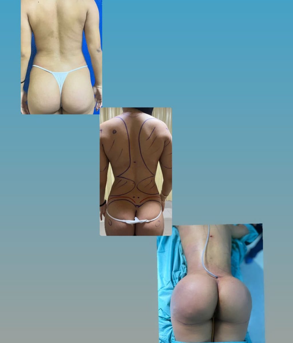 Buttock Augmentation Tijuana